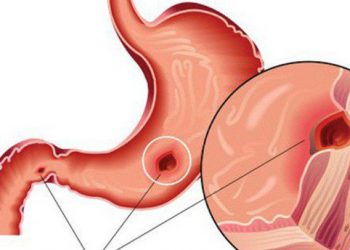 BS cảnh báo: Người trẻ mắc bệnh dạ dày ngày càng nhiều là do đã “cố ý” làm sai 2 điều