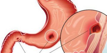 BS cảnh báo: Người trẻ mắc bệnh dạ dày ngày càng nhiều là do đã “cố ý” làm sai 2 điều