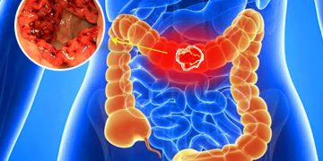 RỐI LOẠN TÍNH CHẤT PHÂN CÓ THỂ CẢNH BÁO BỆNH NGHIÊM TRỌNG, CHỚ CHỦ QUAN!