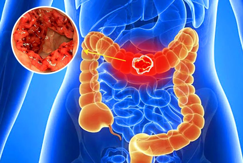 RỐI LOẠN TÍNH CHẤT PHÂN CÓ THỂ CẢNH BÁO BỆNH NGHIÊM TRỌNG, CHỚ CHỦ QUAN!