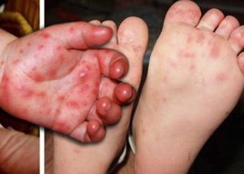 Thiếu thuốc điều trị bệnh tay chân miệng là thông tin không chính xác