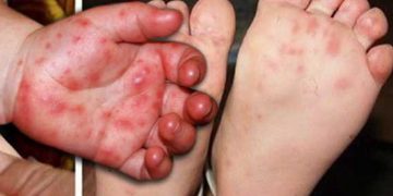 Thiếu thuốc điều trị bệnh tay chân miệng là thông tin không chính xác