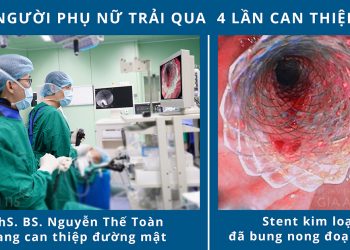 UNG THƯ ĐƯỜNG MẬT NGOÀI GAN, CỤ BÀ PHẢI 3 LẦN ĐẶT STENT ĐƯỜNG MẬT