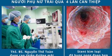 UNG THƯ ĐƯỜNG MẬT NGOÀI GAN, CỤ BÀ PHẢI 3 LẦN ĐẶT STENT ĐƯỜNG MẬT