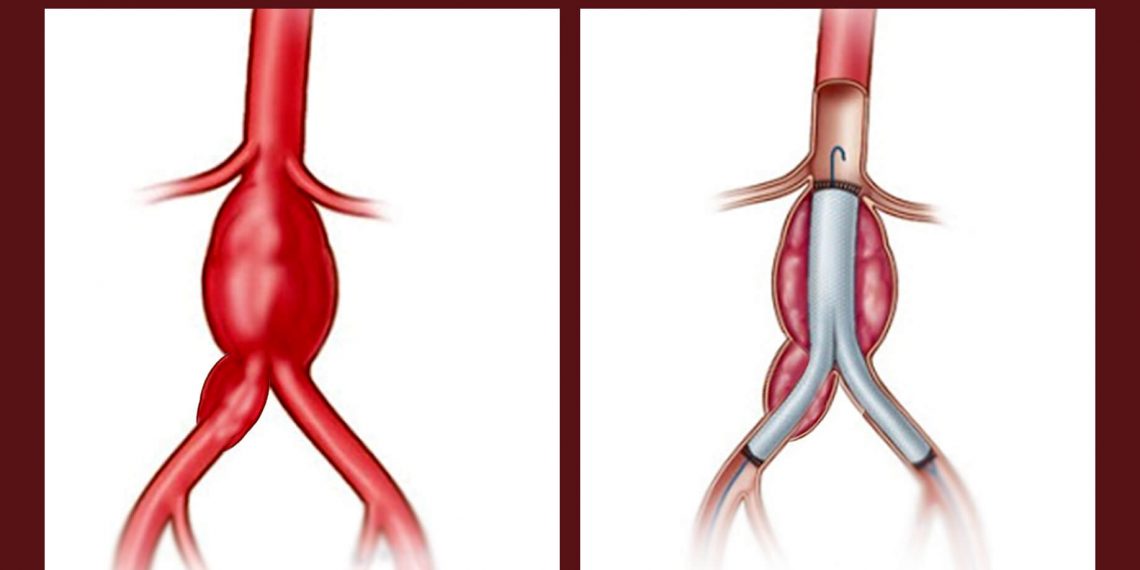 CỨU CỤ ÔNG VỠ PHÌNH ĐỘNG MẠCH CHẬU CHUNG NGUY HIỂM TÍNH MẠNG