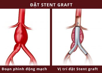 CỨU CỤ ÔNG VỠ PHÌNH ĐỘNG MẠCH CHẬU CHUNG NGUY HIỂM TÍNH MẠNG