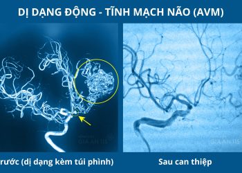 NÊN ĐI KHÁM NGAY NẾU TRONG GIA ĐÌNH CÓ NGƯỜI DỊ DẠNG MẠCH MÁU NÃO!