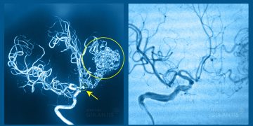 NÊN ĐI KHÁM NGAY NẾU TRONG GIA ĐÌNH CÓ NGƯỜI DỊ DẠNG MẠCH MÁU NÃO!