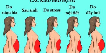 Các dạng bụng mỡ khó giảm, nguyên nhân và cách khắc phục