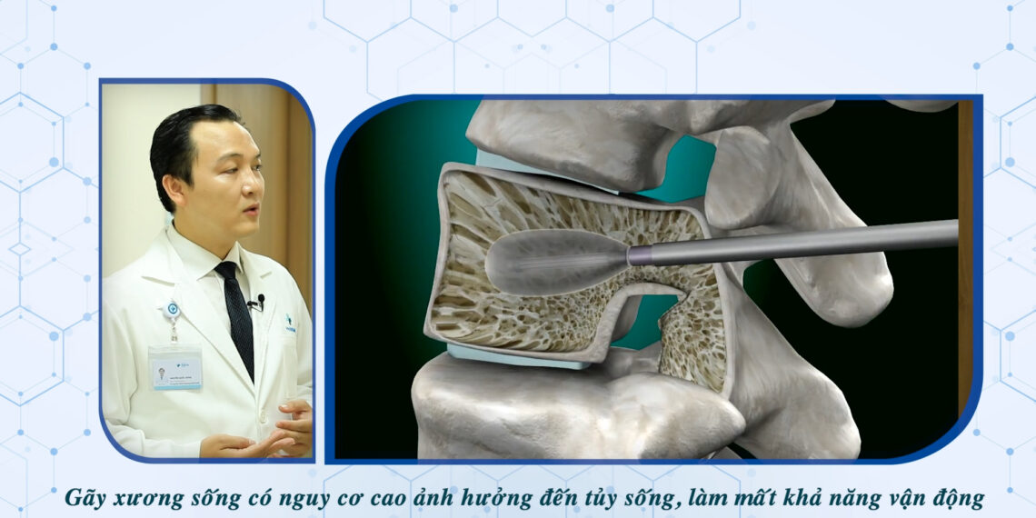 PHÒNG NGỪA GÃY CỘT SỐNG TRÊN NGƯỜI BỆNH LOÃNG XƯƠNG