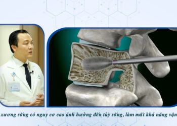 PHÒNG NGỪA GÃY CỘT SỐNG TRÊN NGƯỜI BỆNH LOÃNG XƯƠNG